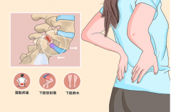 腰椎滑脱的发病原因有哪些 日常如何预防腰椎滑